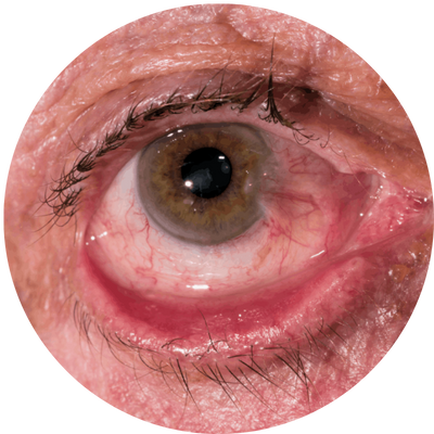 ectrópio, cirurgia