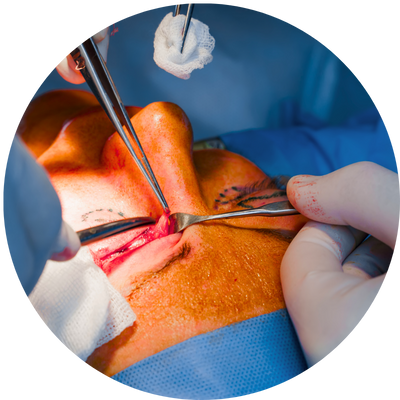 blefaroplastia superior