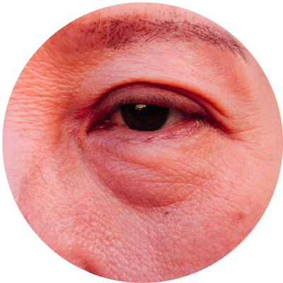 Blefaroplastia inferior