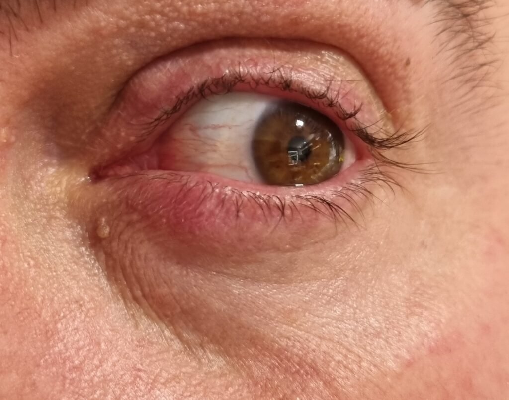 Close-up do olho com calázio na pálpebra inferior