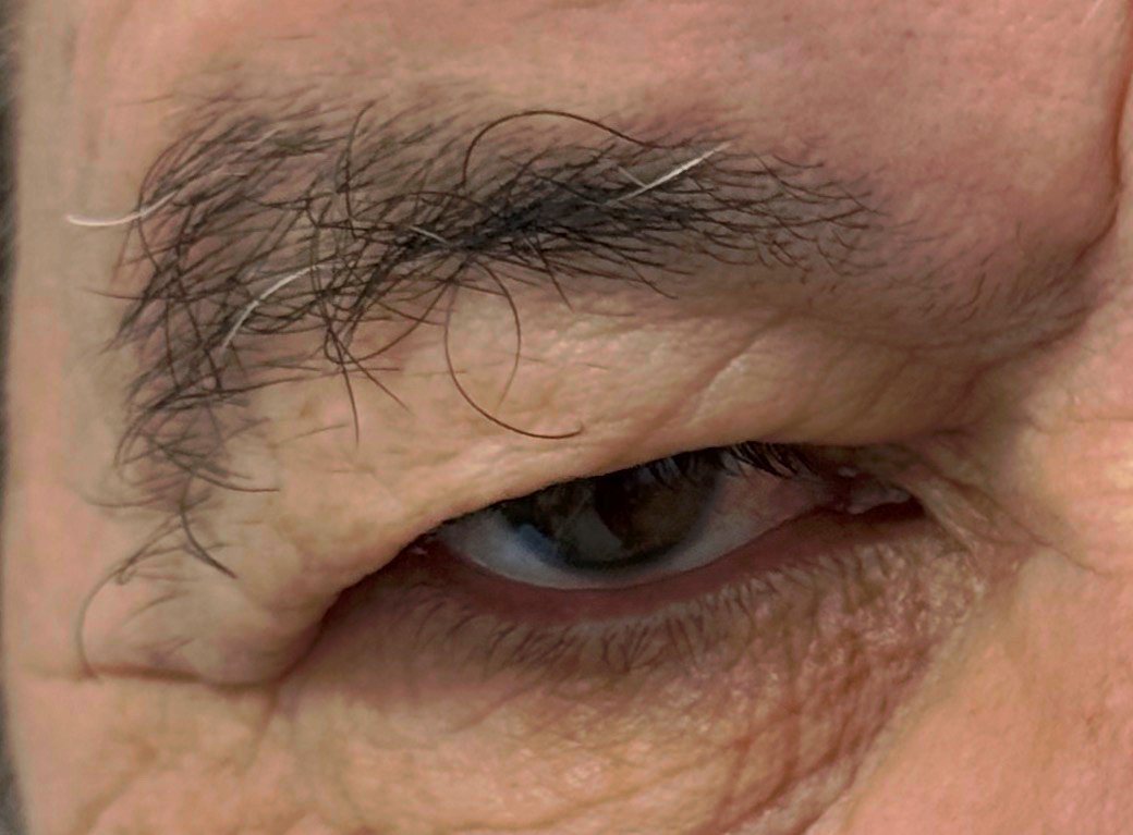 Dermatocálase: excesso de pele na pálpebra superior, sinal que pode indicar cirurgia de pálpebra funcional pelo convênio